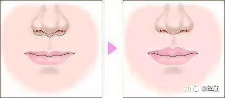 一笑露牙花子能矫正么,一笑就露出牙花怎么办