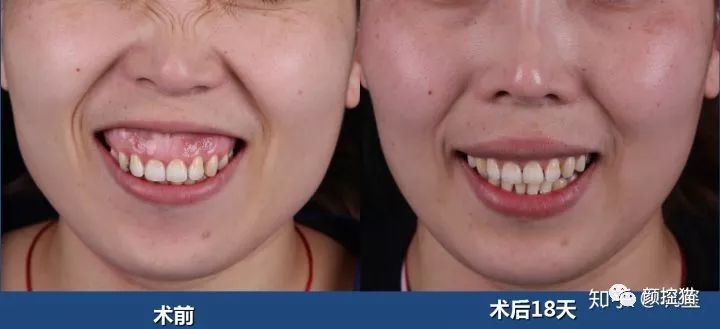 一笑就露出牙花怎么办,口呼吸导致的露龈笑如何治疗
