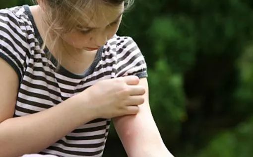 总被蚊子咬?涂点这个马上止痒,还不花一分钱