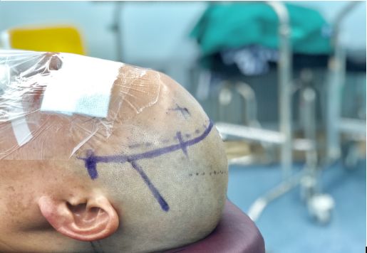 头痛医生说脑子长东西了,头疼头晕是脑袋里长什么东西了