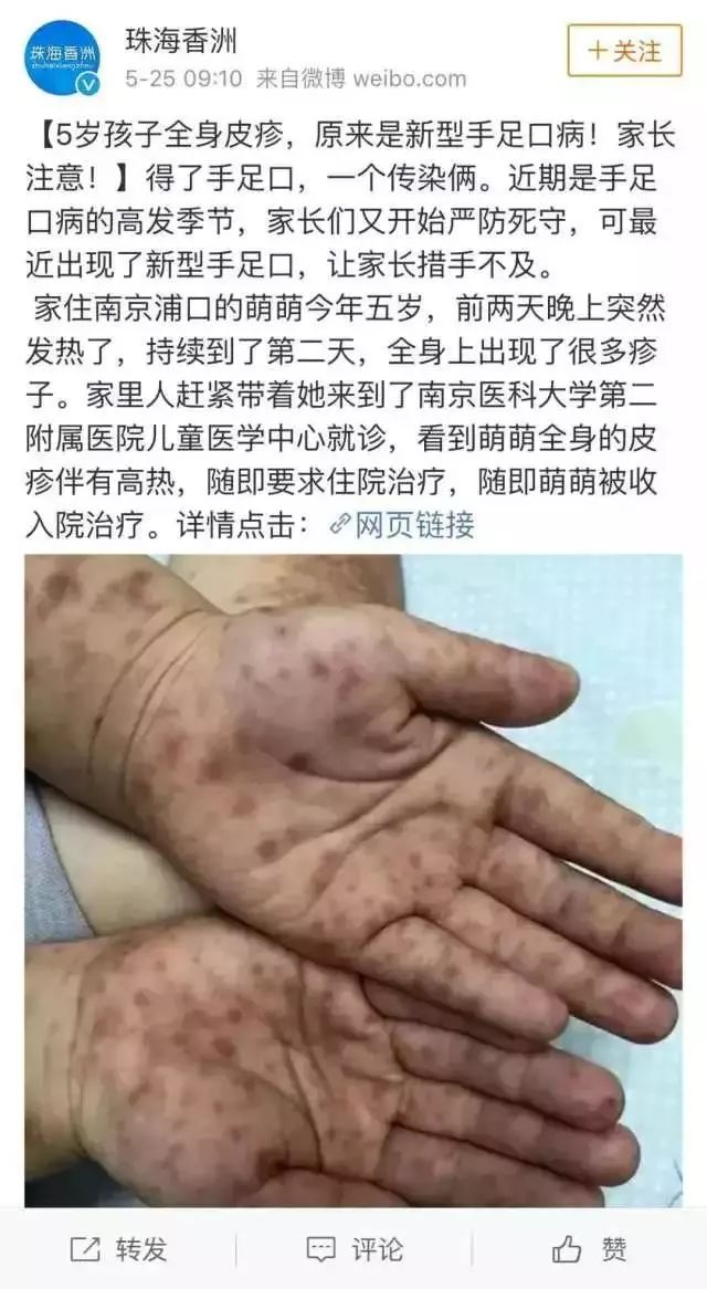 疱疹性咽峡炎和手足口病如何分别,疱疹性咽峡炎和手足口病的对比