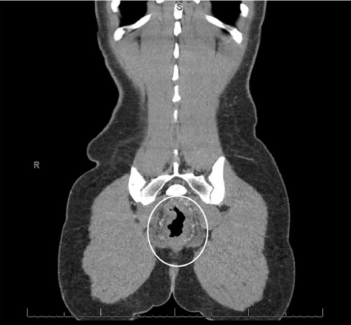 病例分享|一键保存!年轻女性因直肠疼痛而无法坐下?