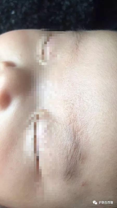 常见面部皮肤病,三脂溢性皮炎