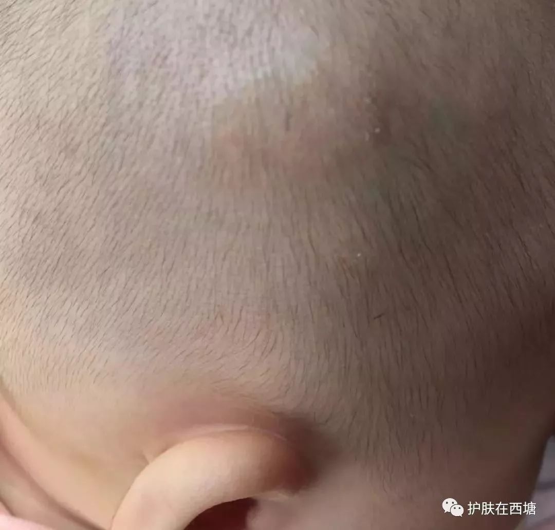 头皮脂溢性皮炎怎么彻底根除,毛囊炎和脂溢性皮炎的区别图