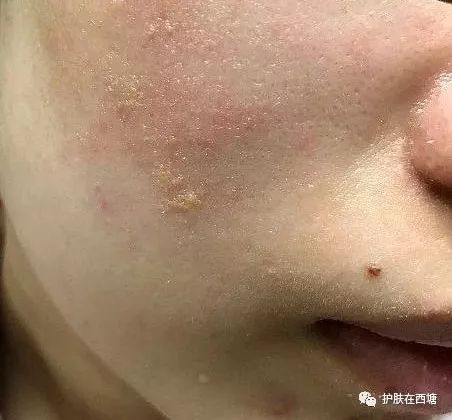 常见面部皮肤病,三脂溢性皮炎