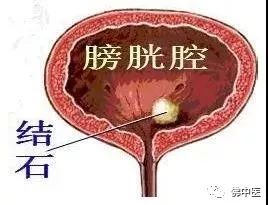 70岁老人前列腺肥大膀胱结石,膀胱巨大结石的症状