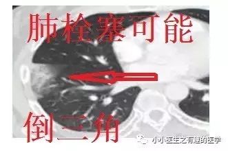 ct平扫肺部能查出是哮喘吗,ct平扫肺结节准确吗