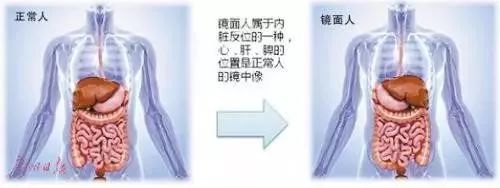 镜面人内脏移植,镜面人胆囊切除