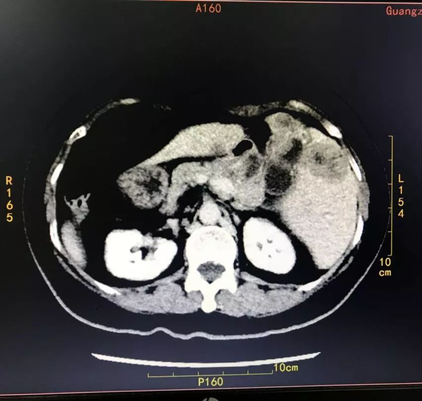 镜面人内脏移植,镜面人胆囊切除