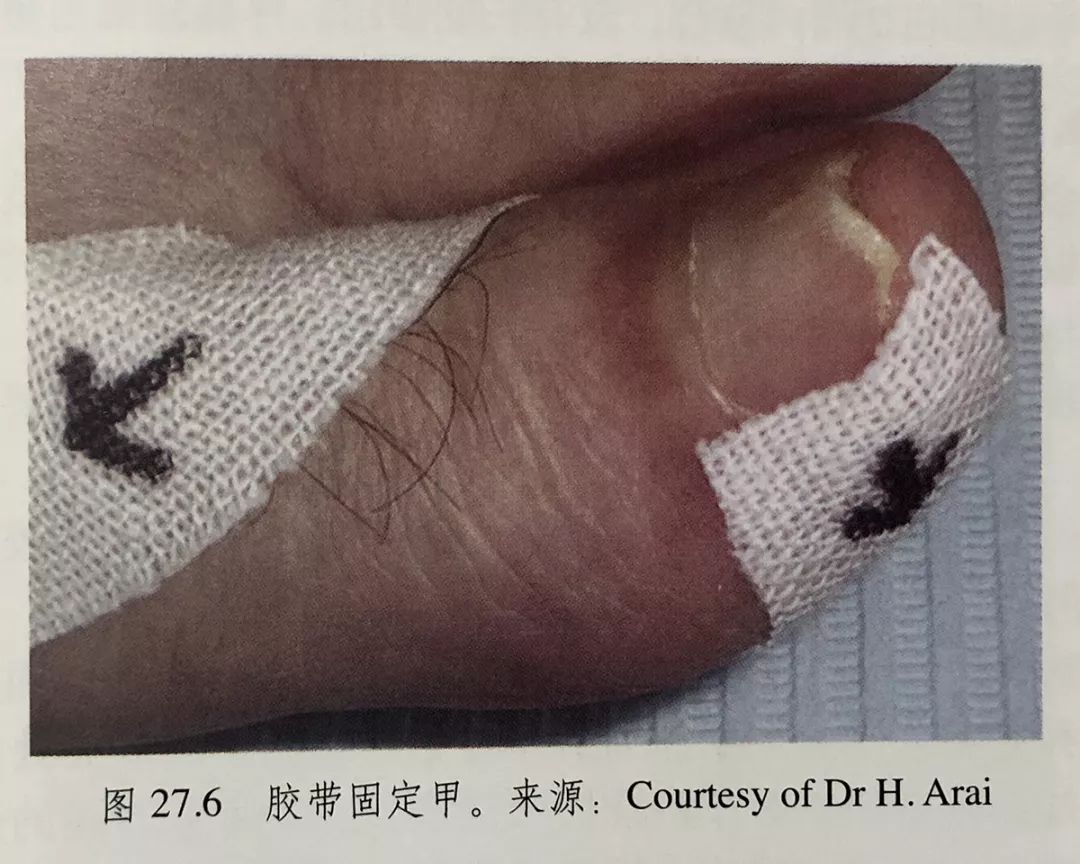 怎么治疗灰趾甲才能彻底不反复,如何快速自然地摆脱指甲真菌