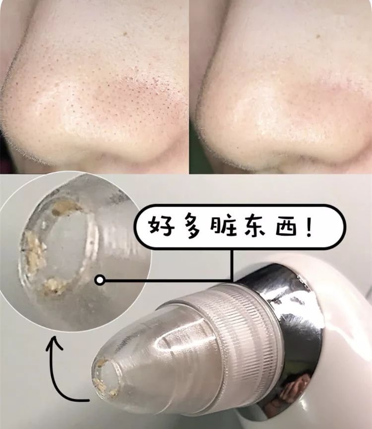 草莓鼻救星怎么治疗,草莓鼻去黑头神器视频