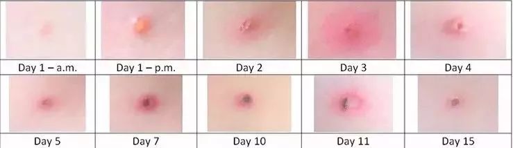 夏季手足口病的预防小知识,手足口水痘注意事项