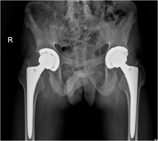 骨道堂治疗强直性脊柱炎效果,御医堂治疗强直性脊柱炎