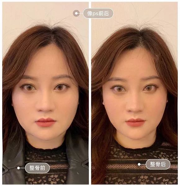 不动刀的整容,不动刀脸部轮廓紧致