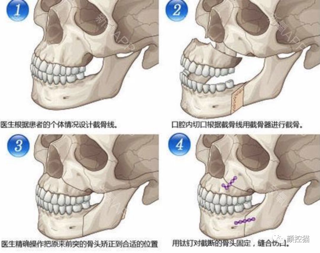 下巴后缩怎么办矫正,下巴后缩怎么办