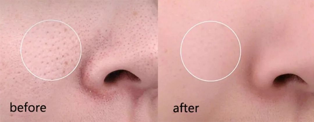 毛孔清道夫冻膜,毛孔清道夫细胞精华驻颜冻膜