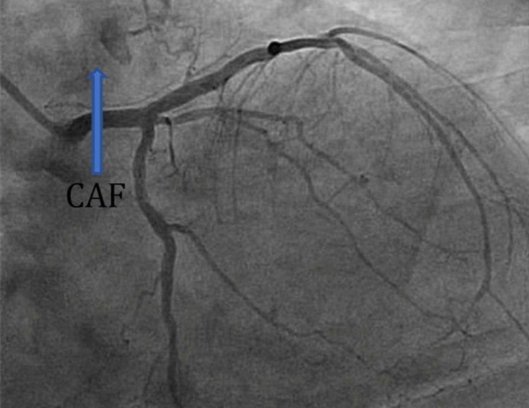 冠状动脉瘘是怎么回事,冠状动脉瘘原因