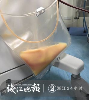 男子腹痛就医抽出牛奶血,男子腹痛住院抽出3000ml牛奶血