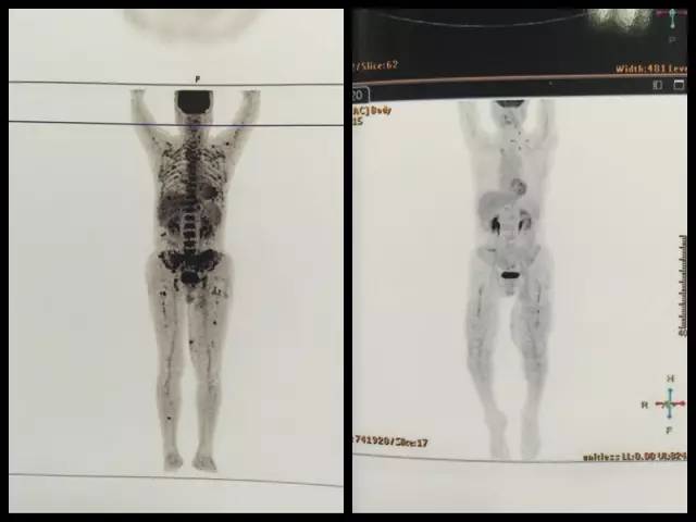 哪个部位的痣会有癌变风险,身体上已有的痣容易癌变吗