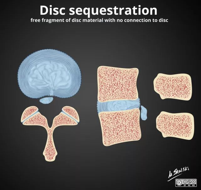 椎间盘膨出脱出图解,椎间盘膨出脱出和突出哪个更严重