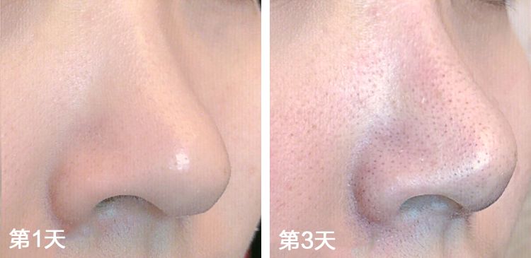 用黑头仪吸完黑头黑头还会再长吗,黑头别膨胀3招把你刷光光