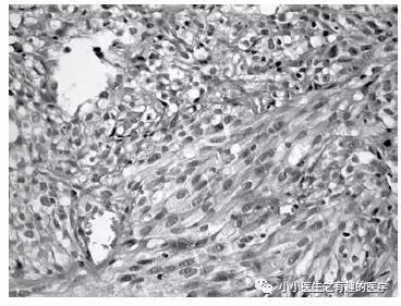 肺动脉分支充盈欠佳是肺栓塞吗,肺动脉缺损不可逆