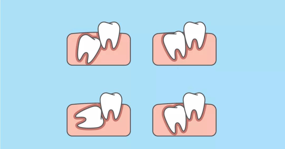 拔智齿为什么要用骨劈开术,智齿只剩牙根拔智齿的全过程