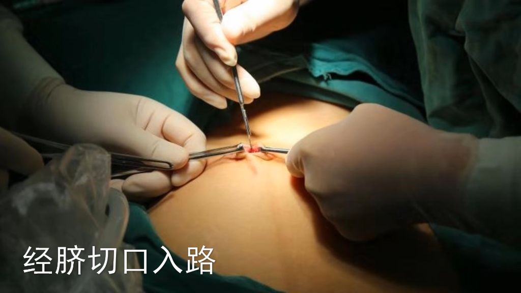 妇产科首例腹腔镜剔除子宫肌瘤,腹腔镜子宫肌瘤11厘米剔除术