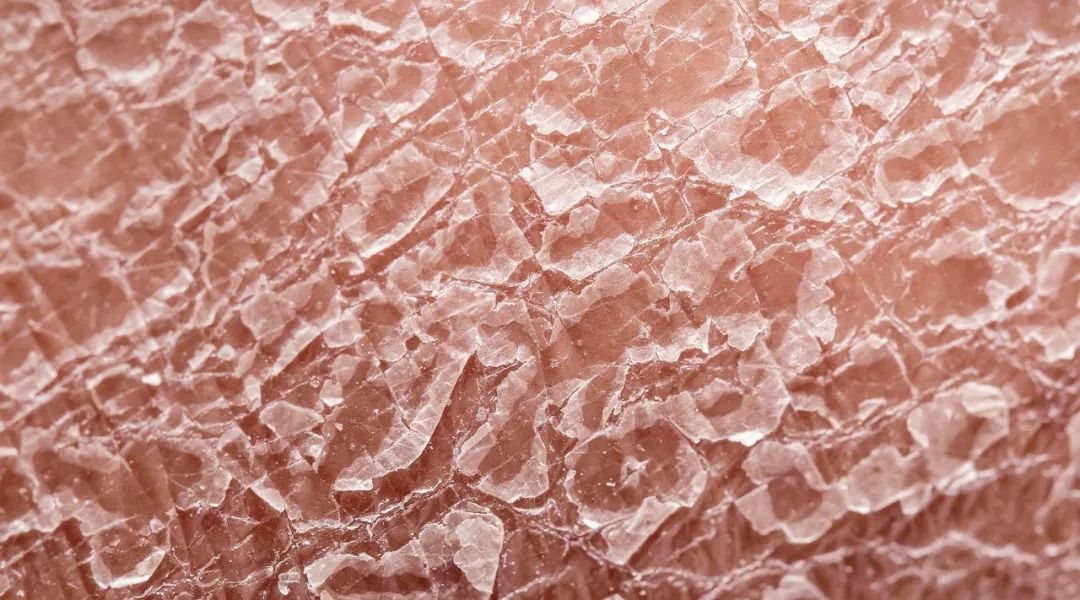 皮肤干燥起皮的救星,皮肤干燥起皮怎么办用什么护肤品