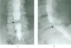 一分钟带你了解腰椎狭窄,椎管狭窄症知识大全