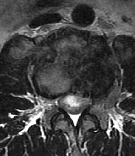 一分钟带你了解腰椎狭窄,椎管狭窄症知识大全