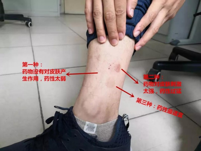 三伏贴真的有那么好的效果吗,三伏贴的优缺点