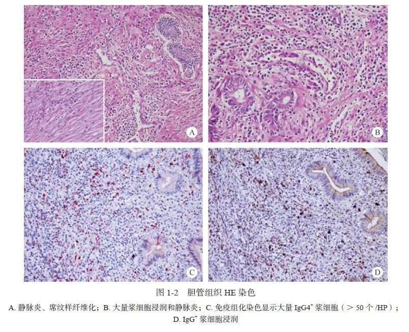 igg4疾病胆管炎会引起ca199升高吗,igg4相关性胆管炎误诊为胆管癌