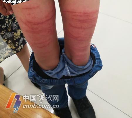 潜水时被水母蜇伤,海边游泳被水母蜇伤