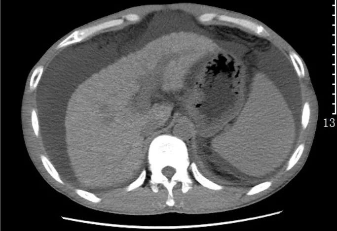 急诊科常见急腹症观察,腹部急诊影像大全值得收藏