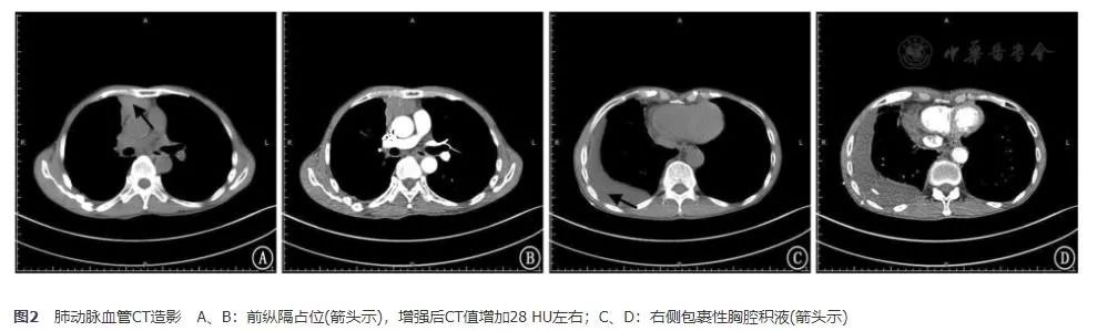 胸腺鳞癌临床出现的几率是多少,胸腺鳞癌一期高分化能活十年吗
