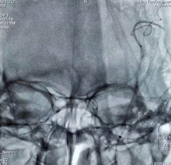 Reco特约·第10期｜国产组合助力取栓“一把通”——Ewata球囊导引导管联合Reco支架取栓分享