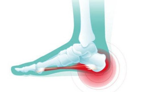 足底筋膜炎与足跟骨刺的治疗方法,筋骨堂治疗骨质增生能去掉吗
