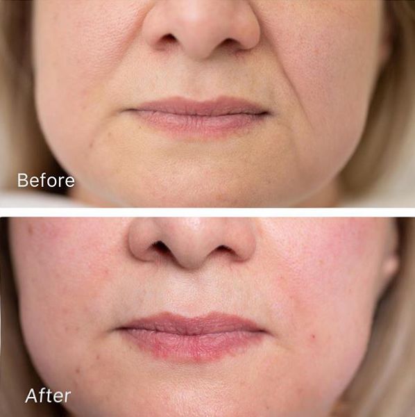 三十岁就有眉间纹法令纹怎么办,30岁法令纹眉心纹深