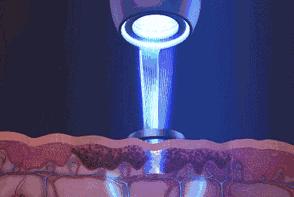 ‘斑’弄是非，超皮秒要你好看