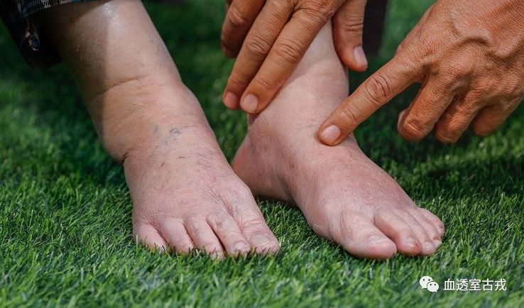 女性尿毒症早期特殊症状和一般症状