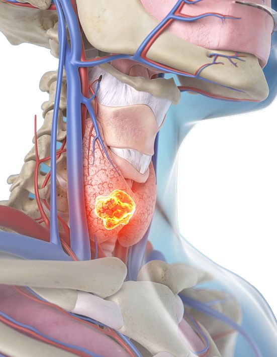 体检发现结节囊肿会变成癌吗,乳腺囊肿增生结节之间的区别