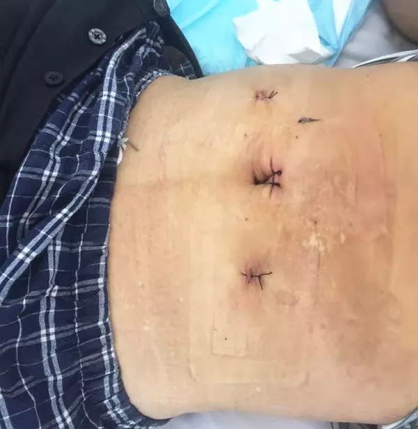 腹股沟疝传统术式最常用,疝气手术第二天需要做什么