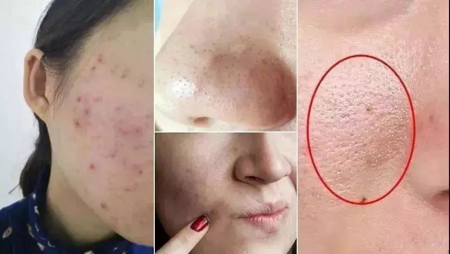 痘痘闭口里面有油脂,鼻子上的痘痘是青春痘还是粉刺