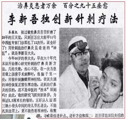 蝶腭神经节对应的穴位治疗鼻炎,耳鼻喉医生治鼻炎