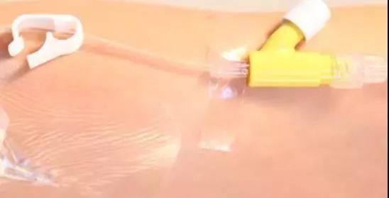 留置针堵了强行冲管会栓塞吗,留置针堵塞拔针好还是强行冲管好