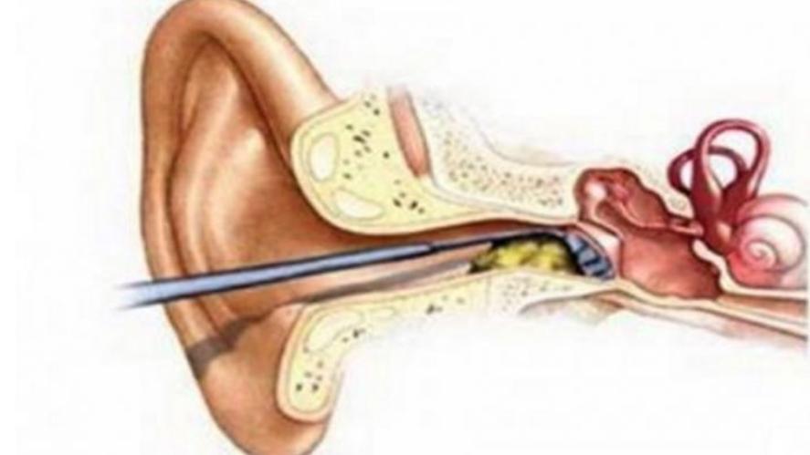 通过耳屎判断健康,关于耳屎你必须知道的几件事