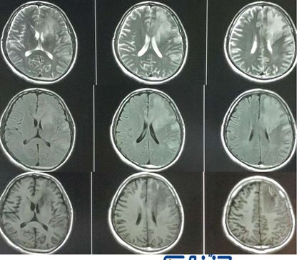 Rasmussen脑炎、结核性肉芽肿、脑发育性静脉畸形丨3分钟读片·第13期,下）