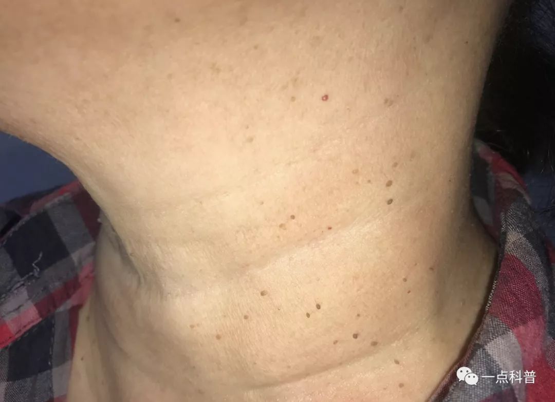 老年人皮肤癌是怎么得的,老人脸上长肉粒是皮肤癌吗