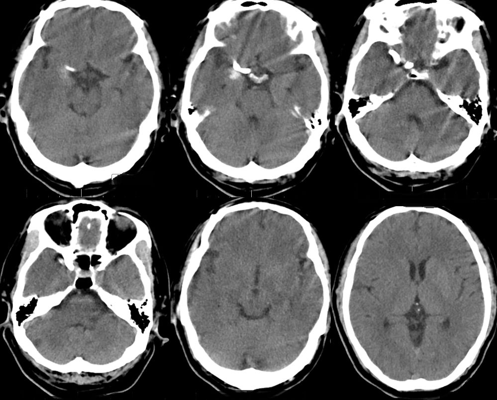治疗颅内动脉瘤新型密网支架,pipeline治疗椎动脉夹层动脉瘤